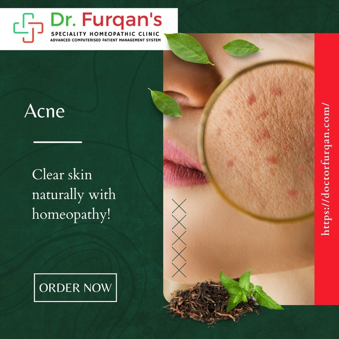 Acne-free skin with personalized homeopathy solutions.